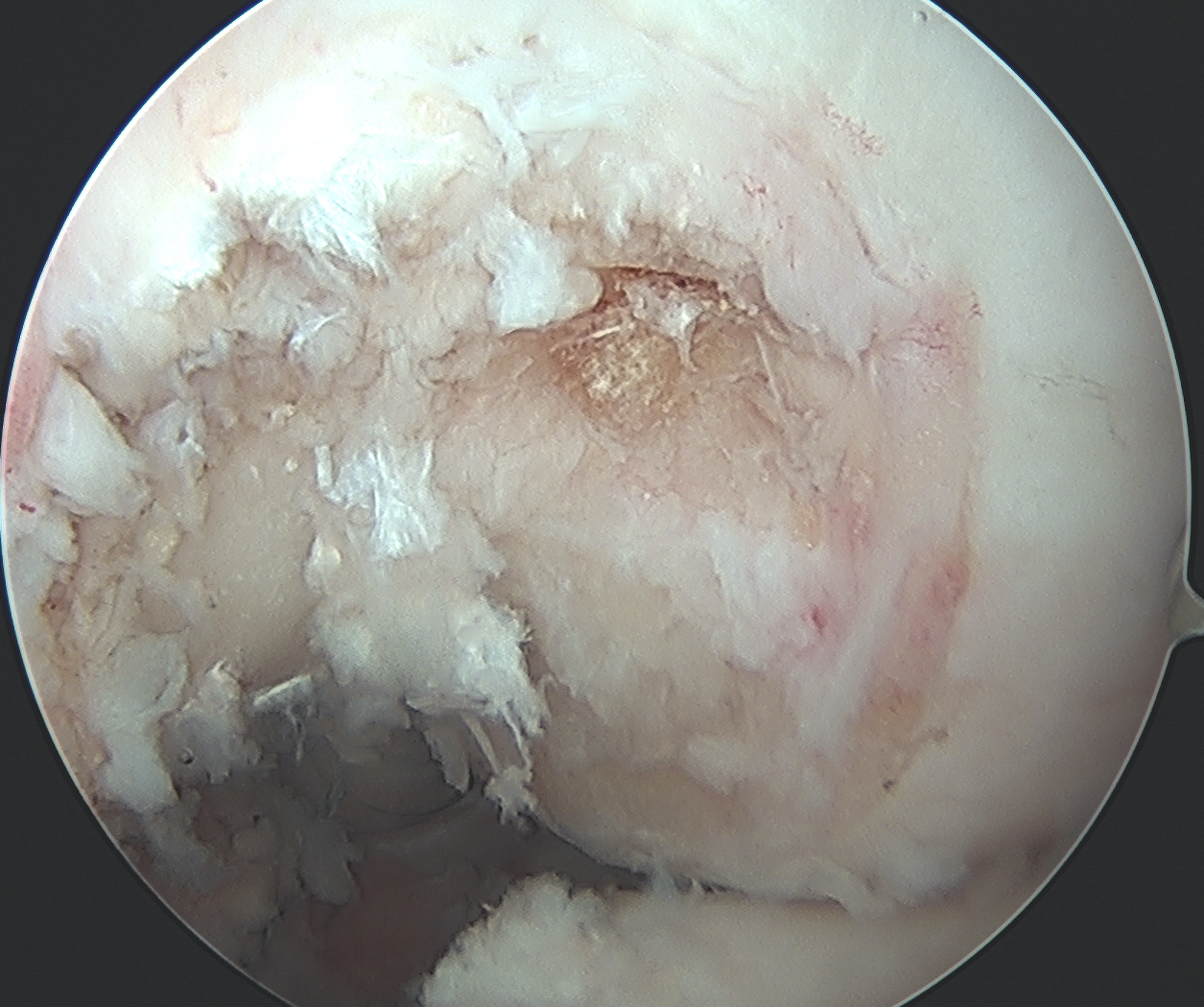PCL femoral tunnel 1